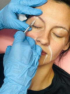 Brow lift