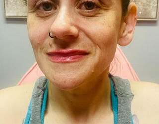After Lip Flip and Filler