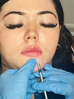 Lip Filler