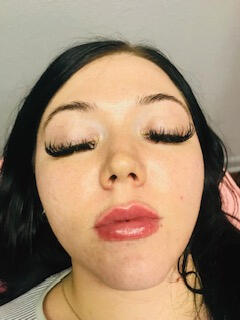 After Lip Filler