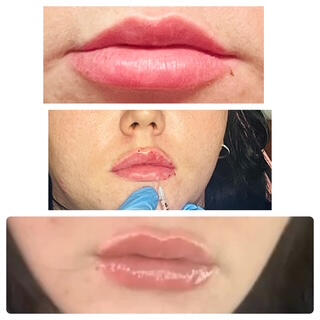 Lip Filler