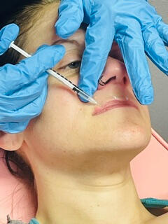 Lip Flip and Filler
