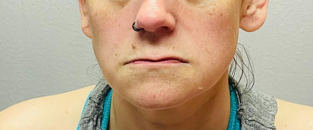 Before Lip Flip and Filler
